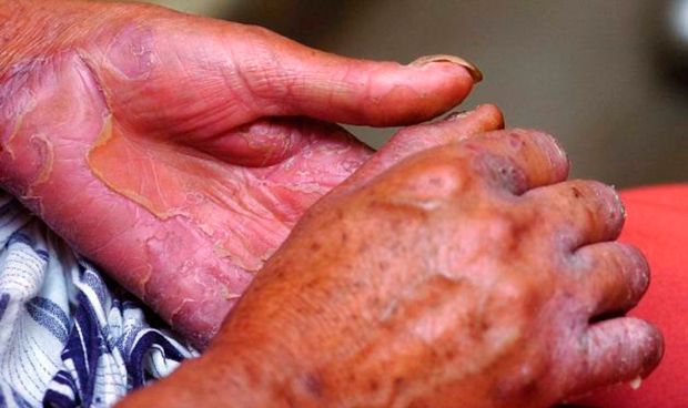 Los casos de lepra crecen un 1,9% en 2016, la primera subida en cuatro años