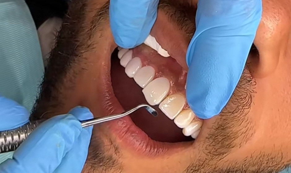 Los dentistas alertan sobre el turismo dental en Marruecos