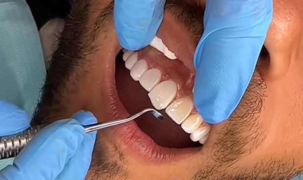 Los dentistas alertan sobre el turismo dental en Marruecos