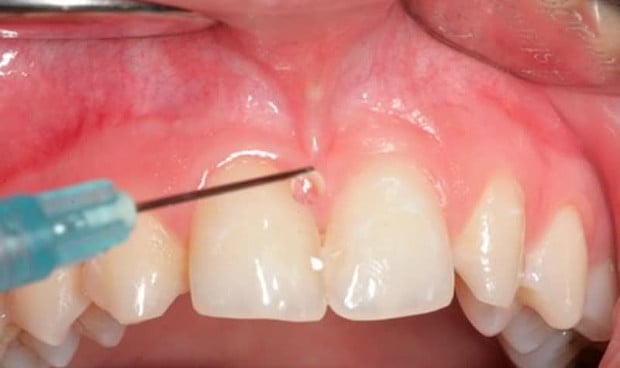  Los dentistas celebran la nueva regulación gallega que explica qué regula su uso en sanidad