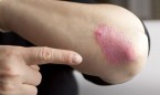 Los dermatólogos británicos cuestionan la relación entre psoriasis y cáncer