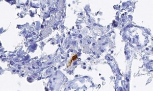 Los herpes manipulan el sistema inmunológico conduciendo al alzhéimer