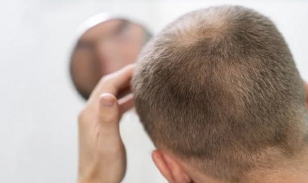 Inhibidores JAK frente alopecia