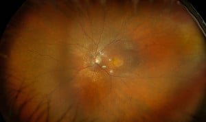 Los oftalmólogos alertan de que fumar también acelera la pérdida de visión