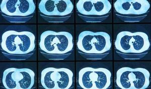 Los programas de 'screening' reducen la mortalidad del cáncer de pulmón