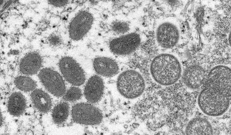 Los síntomas de la viruela del mono, su tratamiento y modos de contagio
