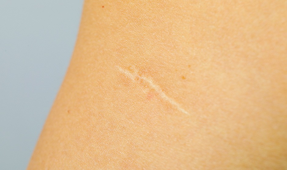 Los trasplantes de folículos pilosos favorecen la remodelación de la piel