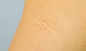 Los trasplantes de folículos pilosos favorecen la remodelación de la piel