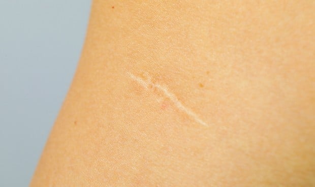 Los trasplantes de folículos pilosos favorecen la remodelación de la piel