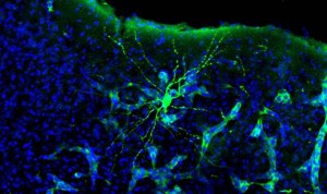 Los tumores cerebrales 'hackean' la comunicación entre las neuronas