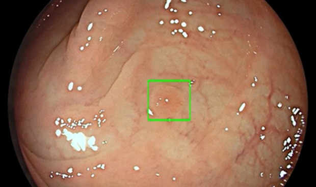 Medtronic lanza la primera inteligencia artificial para colonoscopia 