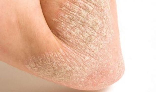 Mejorar la salud de la piel reduce el riesgo de diabetes tipo 2