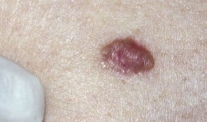 Una nueva terapia evita que el melanoma se vuelva más agresivo