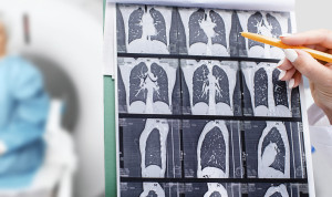 Neumología pide mejorar la sospecha clínica en bronquiectasias