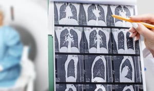 Neumología pide mejorar la sospecha clínica en bronquiectasias