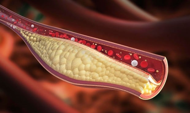 Novartis muestra eficacia de su fármaco para arteriosclerosis