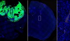 Nueva diana ‘made in Spain’ contra el agresivo y letal glioblastoma