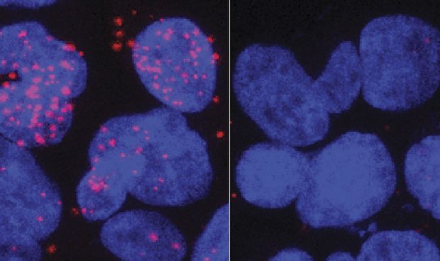 Nueva diana teraputica para casos resistentes de cncer de prstata