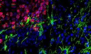 Nueva estrategia para combatir metástasis cerebrales en melanoma