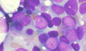 Nuevos marcadores biológicos, claves en el pronóstico de la leucemia