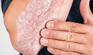 Los pacientes con psoriasis no son más susceptibles al Covid-19