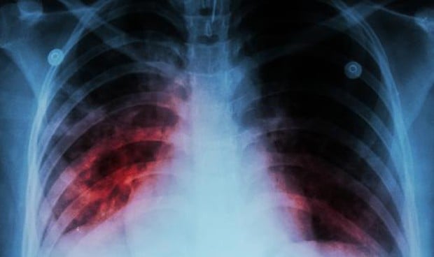País Vasco activa el protocolo por tuberculosis tras un caso en Vitoria