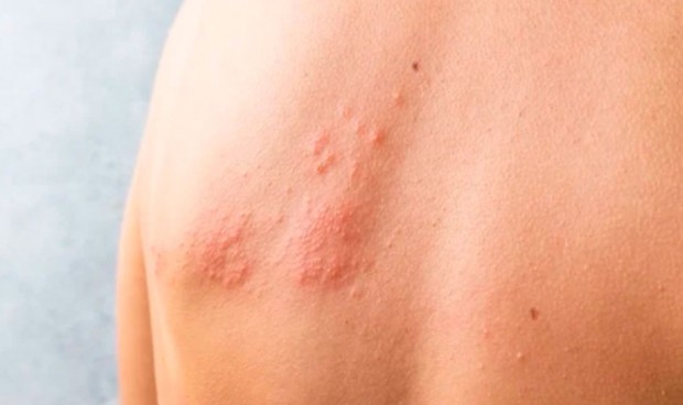 País Vasco amplía la campaña de vacunación contra el herpes zóster