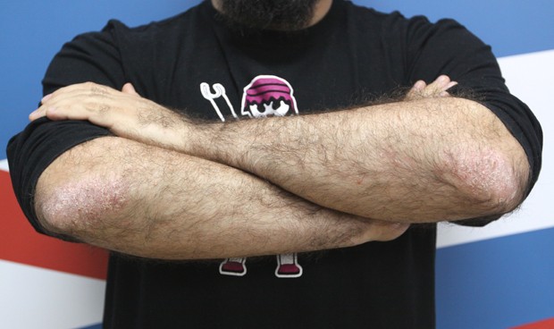 Perder peso mejora los síntomas de la psoriasis