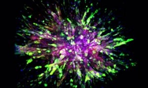 Pertuzumab reduce el riesgo de reaparición de cáncer de mama precoz