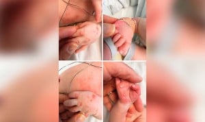 Primer caso de viruela del mono en un bebé recién nacido: en UCI 14 días