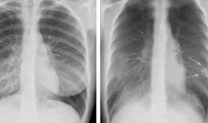 Prioridad a las radiografías que muestran fracturas gracias a un algoritmo