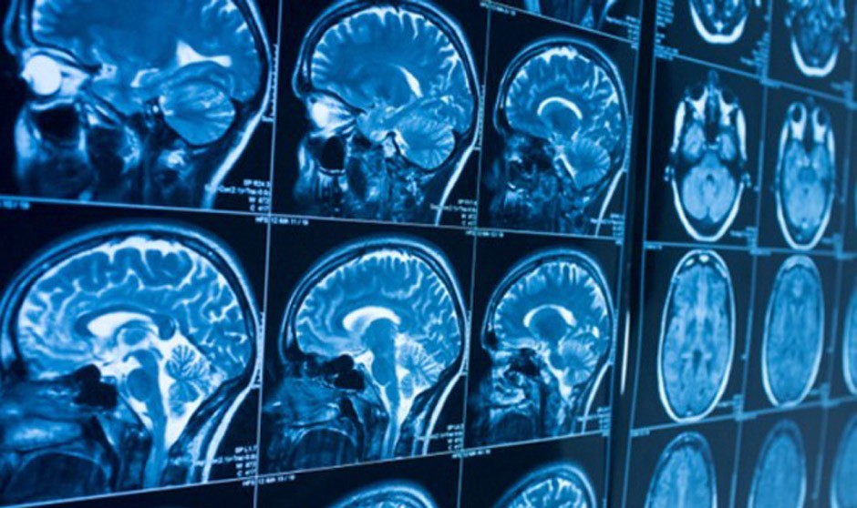 Problemas de memoria en pacientes Covid hasta dos meses después del alta