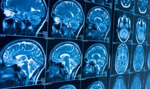 Problemas de memoria en pacientes Covid hasta dos meses después del alta