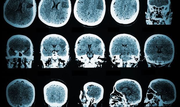 Pruebas genéticas determinan epilepsia en niños con convulsiones