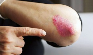 Psoriasis e hígado graso no alcohólico están estrechamente relacionados