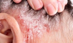 Psoriasis: el metotrexato aumenta el riesgo de complicación hepática grave