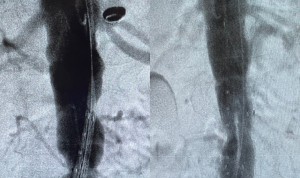 Quirónsalud Clideba consigue reparar una aorta con riesgo de rotura