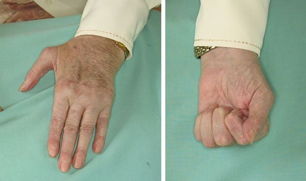 Quirónsalud ofrece una terapia que mejora la artritis reumatoide en 4 meses