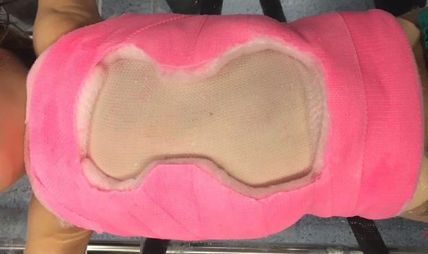 Quirónsalud trata la escoliosis de inicio temprano con una nueva técnica