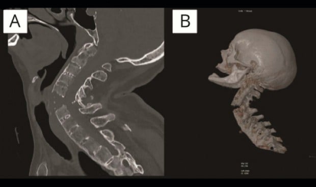 Quiropráctica desliga el caso de fractura cervical del estándar formativo