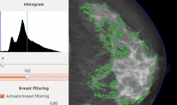 Regalan un software que predice el riesgo de tener cáncer de mama