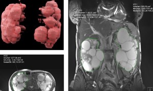 Resona (Asisa) amplía su capacidad de diagnóstico en patologías renales