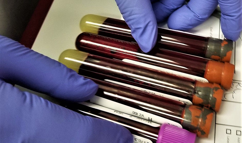 Respuesta "significativa" al combinar ibrutinib y rituximab en linfoma