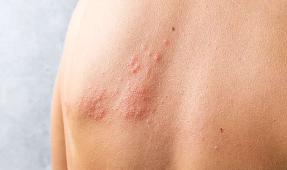 Salud vacunará contra la profilaxis del herpes zóster a mayores de 65 años