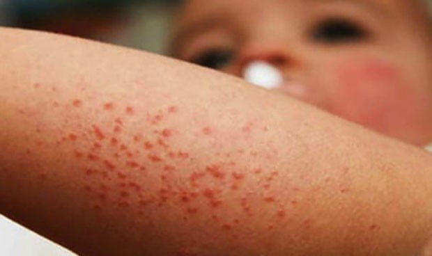 El sarampión puede resurgir "con toda su fuerza" por una menor vacunación