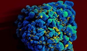 Segundo paciente con VIH que elimina el virus sin recibir tratamiento