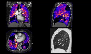 Siemens logra cuatro tipos de imágenes distintas en un solo TAC