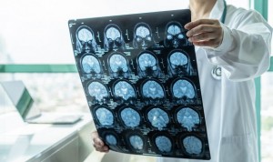 Un 60% de europeos con enfermedad neurológica rara no son diagnosticados