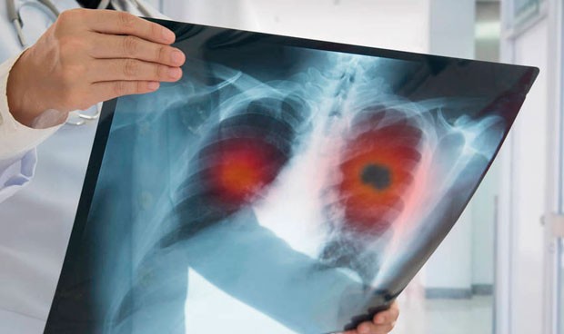 Un algoritmo de Google detecta el cáncer de pulmón más rápido que un médico