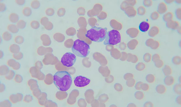 Un algoritmo logra organizar las mutaciones de la leucemia linfocítica